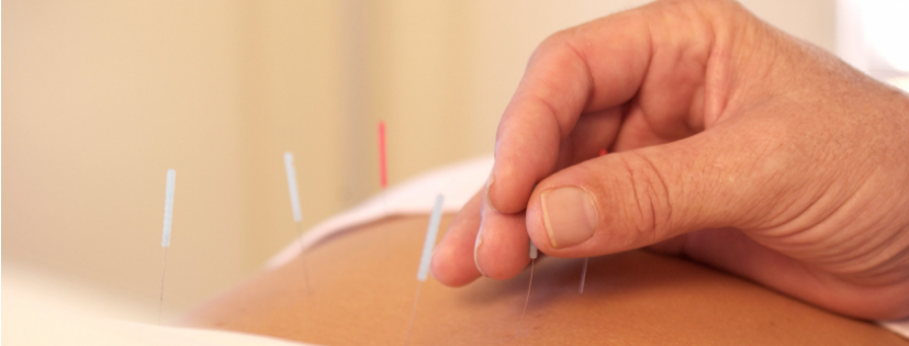 Dry Needling